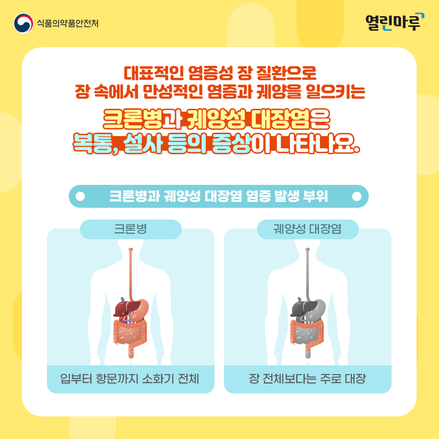 대표적인 염증성 장 질환으로 장 속에서 만성적인 염증과 궤양을 일으키는 크론병과 궤양성 대장염은 복통, 설사 등의 증상이 나타나요. '크론병과 궤양성 대장염 염증 발생 부위 - 크론병(입부터 항문까지 소화기 전체), 궤양성 대장염(장 전체보다는 주로 대장)'